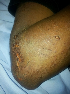 Kiwanuka with bruises.