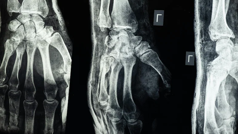 Chinese Scientists Create “Bone Glue” That Heals Fractures in Minutes Chinese Scientists Create "Bone Glue" That Heals Fractures in Minutes